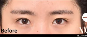 Before