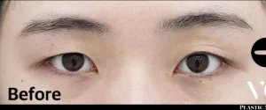 Before