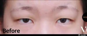 Before
