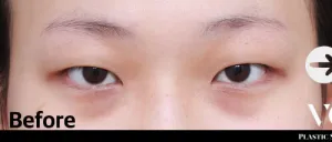 Before
