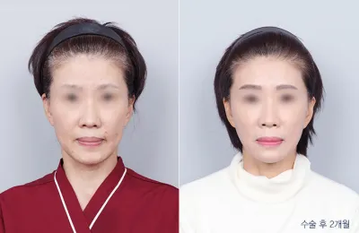 Before & After