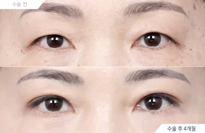 Before & After
