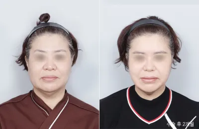Before & After