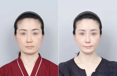 Before & After