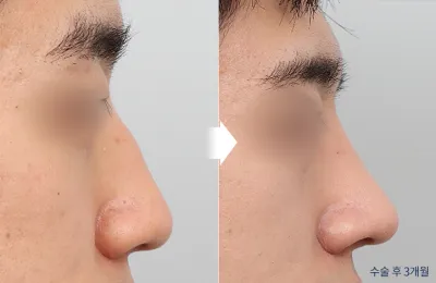 Before & After