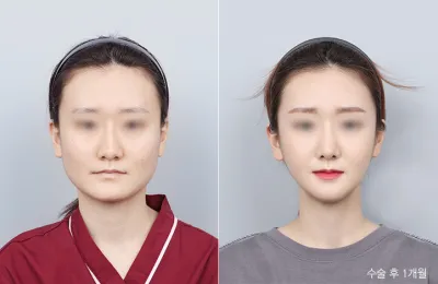 Before & After