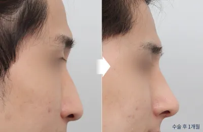 Before & After