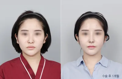 Before & After