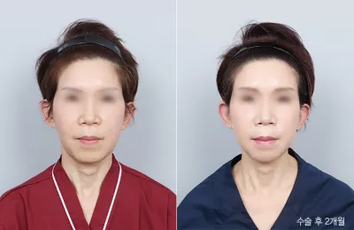 Before & After