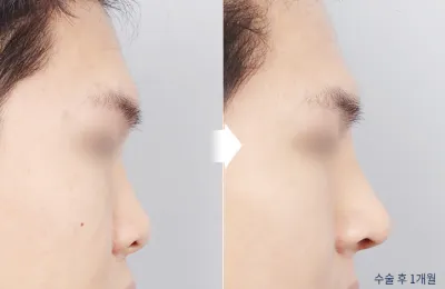 Before & After