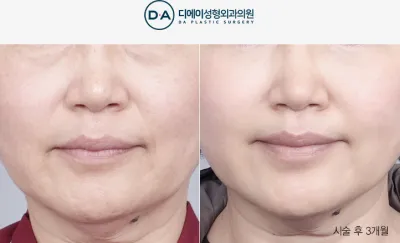 Before & After