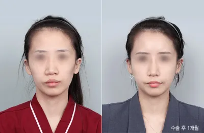 Before & After