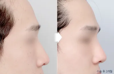 Before & After