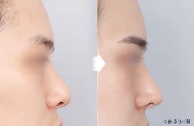 Before & After