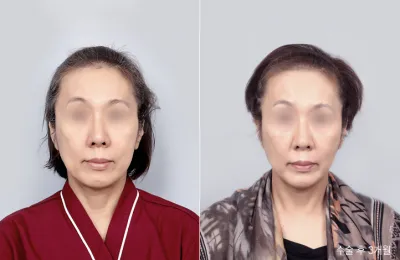 Before & After