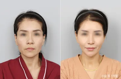 Before & After