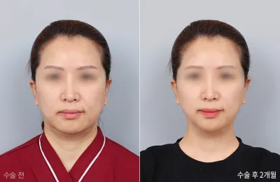 Before & After