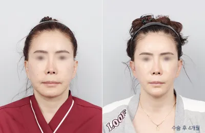 Before & After