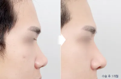 Before & After