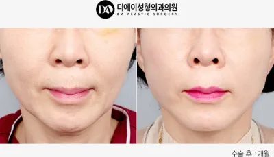 Before & After