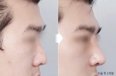Before & After