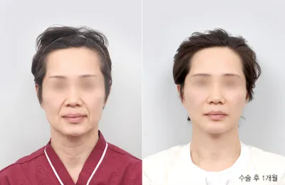 Before & After