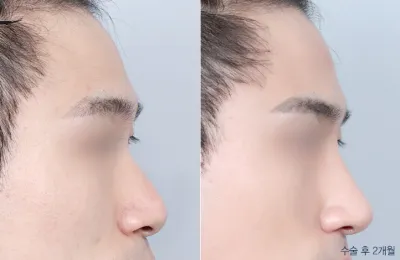 Before & After