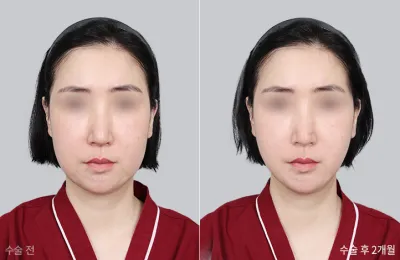 Before & After