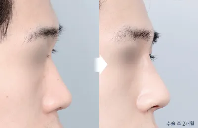Before & After