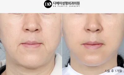 Before & After