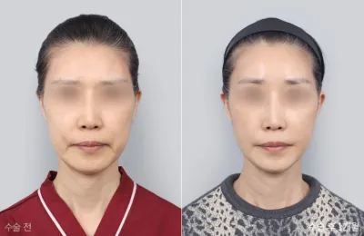 Before & After