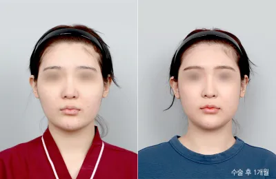 Before & After