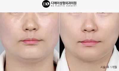 Before & After