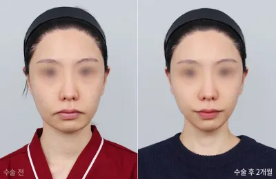 Before & After