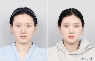 Before & After