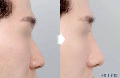 Before & After
