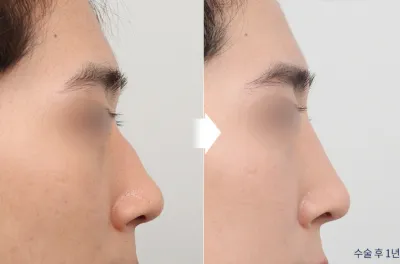 Before & After