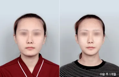 Before & After