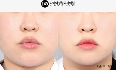 Before & After