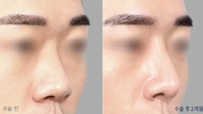Before & After