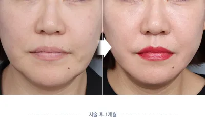 Before & After