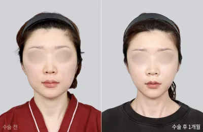 Before & After
