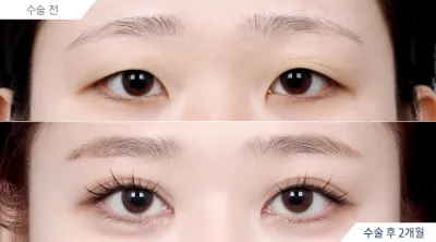Before & After