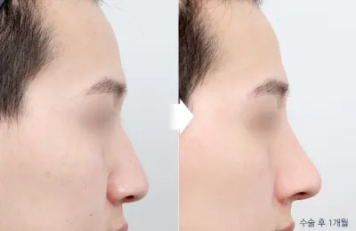Before & After