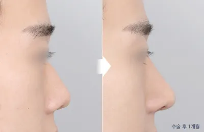 Before & After