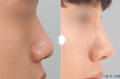Before & After