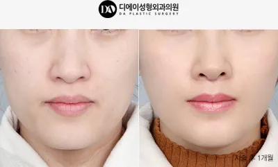 Before & After