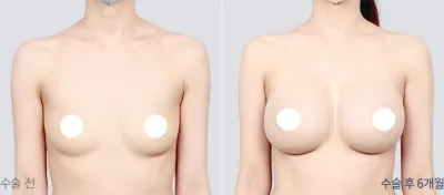 Before & After