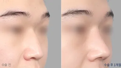 Before & After