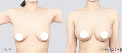 Before & After